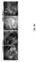 Fig. 07 - Use of endogenous fluorescence to identify invading metastatic breast tumor cells
