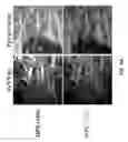 Fig. 16 - Use of endogenous fluorescence to identify invading metastatic breast tumor cells