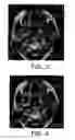 Fig. 03 - Method for culturing dendritic cells (DC) and cytokine-induced killer cells (D-CIK) and applications thereof
