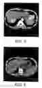 Fig. 04 - Method for culturing dendritic cells (DC) and cytokine-induced killer cells (D-CIK) and applications thereof