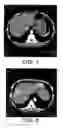 Fig. 05 - Method for culturing dendritic cells (DC) and cytokine-induced killer cells (D-CIK) and applications thereof