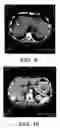Fig. 06 - Method for culturing dendritic cells (DC) and cytokine-induced killer cells (D-CIK) and applications thereof