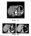 Fig. 07 - Method for culturing dendritic cells (DC) and cytokine-induced killer cells (D-CIK) and applications thereof