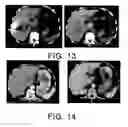 Fig. 08 - Method for culturing dendritic cells (DC) and cytokine-induced killer cells (D-CIK) and applications thereof