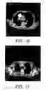 Fig. 10 - Method for culturing dendritic cells (DC) and cytokine-induced killer cells (D-CIK) and applications thereof