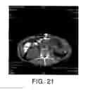 Fig. 13 - Method for culturing dendritic cells (DC) and cytokine-induced killer cells (D-CIK) and applications thereof