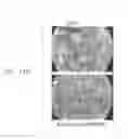 Fig. 19 - Methods and compositions for reducing activity of the atrial natriuretic peptide receptor and for treatment of diseases