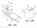 Fig. 10 - Therapeutic method and therapeutic system used with steps for approaching to lesion using overtube