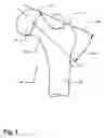 Fig. 02 - Method and apparatus for computer-assisted femoral head resurfacing