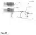 Fig. 12 - Method and apparatus for computer-assisted femoral head resurfacing