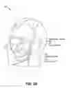 Fig. 04 - Method and system for noninvasive face lifts and deep tissue tightening