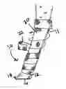 Fig. 01 - Leg splint