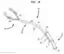 Fig. 02 - Splitable tip catheter with bioresorbable adhesive