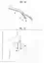 Fig. 03 - Splitable tip catheter with bioresorbable adhesive