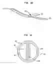 Fig. 11 - Splitable tip catheter with bioresorbable adhesive