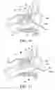 Fig. 07 - Method for treating obstructed paranasal maxillary sinuses