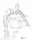 Fig. 03 - INTUBATION DEVICES AND METHODS OF USE THEREOF