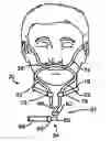 Fig. 01 - Method and device for non-invasive ventilation with nasal interface