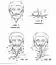 Fig. 02 - Method and device for non-invasive ventilation with nasal interface