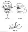 Fig. 17 - Method and device for non-invasive ventilation with nasal interface