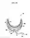 Fig. 03 - Methods and devices for relieving upper airway obstructions