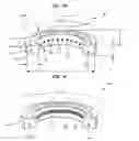 Fig. 07 - Methods and devices for relieving upper airway obstructions