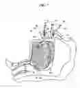 Fig. 13 - Methods and devices for relieving upper airway obstructions