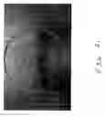 Fig. 15 - Therapeutic tool and method for use thereof