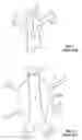 Fig. 02 - ISOLATION DEVICES FOR THE TREATMENT OF ANEURYSMS