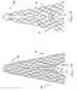 Fig. 09 - Vascular prosthesis with alternating helical sections