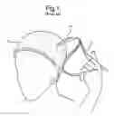 Fig. 02 - Tool for separating a hair bundle