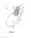 Fig. 03 - METHODS AND APPARATUS FOR PATIENT NOTIFICATION OF PHYSIOLOGIC EVENTS AND DEVICE FUNCTION