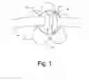 Fig. 02 - Eyewear frame adornment attaching device