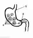 Fig. 01 - Ingestible formulations for transient, noninvasive reduction of gastric volume