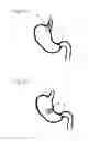 Fig. 03 - Ingestible formulations for transient, noninvasive reduction of gastric volume