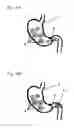 Fig. 05 - Ingestible formulations for transient, noninvasive reduction of gastric volume
