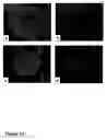 Fig. 17 - Methods of treating neurological conditions with hematopoeitic growth factors