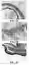 Fig. 04 - Method and reagents for the enhancement of virus transduction in the bladder epithelium