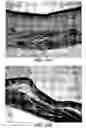 Fig. 22 - Method and reagents for the enhancement of virus transduction in the bladder epithelium