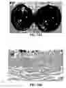 Fig. 49 - Method and reagents for the enhancement of virus transduction in the bladder epithelium