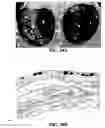 Fig. 57 - Method and reagents for the enhancement of virus transduction in the bladder epithelium