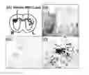 Fig. 01 - Use Of Mesenchymal Stem Cells Genetically Modified To Express A Suicide Gene For Treating A Cancer