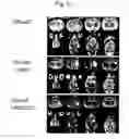 Fig. 10 - Use Of Mesenchymal Stem Cells Genetically Modified To Express A Suicide Gene For Treating A Cancer