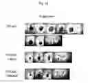 Fig. 11 - Use Of Mesenchymal Stem Cells Genetically Modified To Express A Suicide Gene For Treating A Cancer