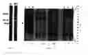Fig. 02 -  mutation T1796A in thyroid cancers