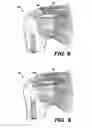 Fig. 07 - METHOD OF PREPARATION OF BIOABSORBABLE POROUS REINFORCED TISSUE IMPLANTS AND IMPLANTS THEREOF