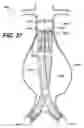 Fig. 16 - LOCAL VASCULAR DELIVERY OF PROBUCOL ALONE OR IN COMBINATION WITH SIROLIMUS TO TREAT RESTENOSIS, VULNERABLE PLAQUE, AAA AND STROKE