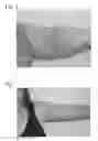 Fig. 04 - Method of treating scar tissue