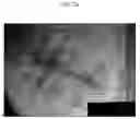 Fig. 11 - Composition for Prevention and Treatment of Stretch Mark Comprising Citric Acid, Zinc and Arginine