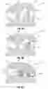 Fig. 03 - TWO-PART SELF-LIGATING ORTHODONTIC BRACKET HAVING LATERAL GUIDING MECHANISM